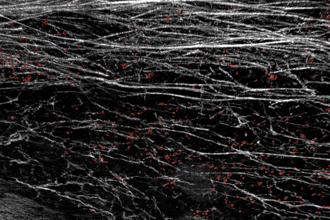 A microscope image of red immune cells and white fibrous collagen